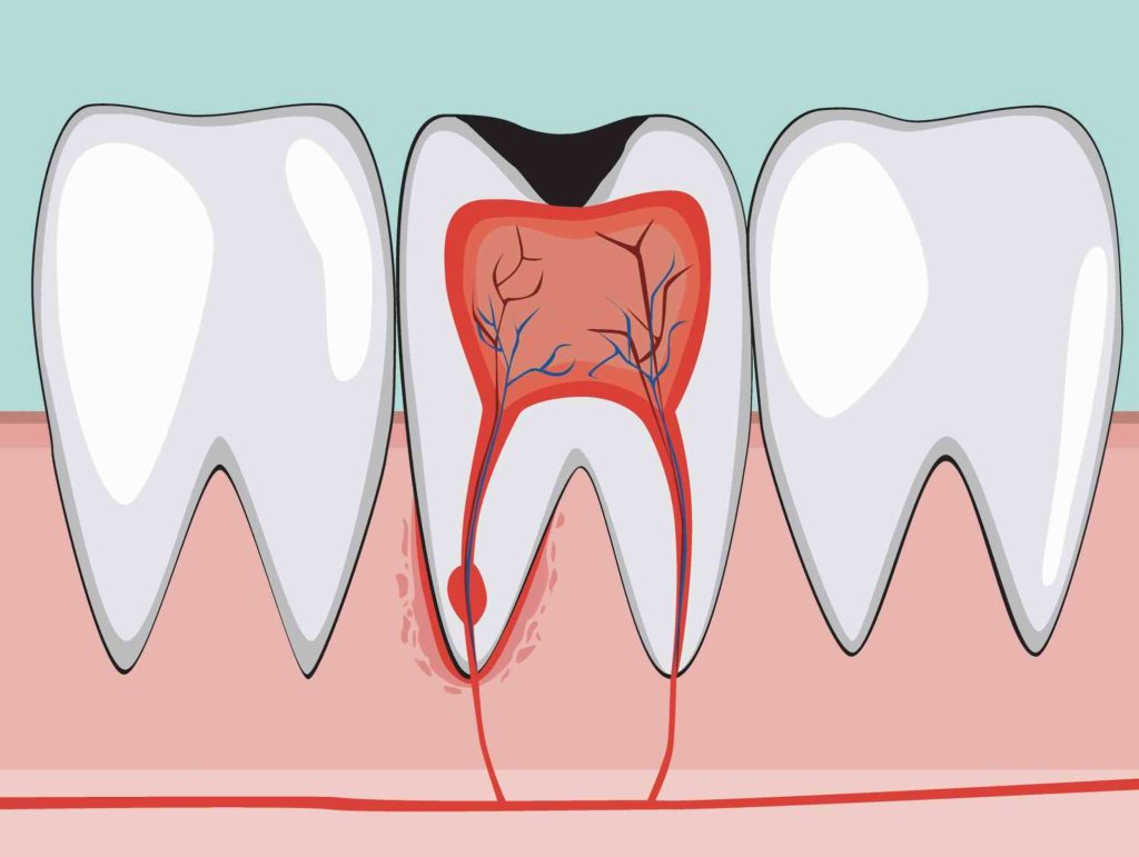 Viêm tủy răng có thể phát triển qua nhiều giai đoạn khác nhau, mỗi giai đoạn có các đặc điểm và triệu chứng riêng