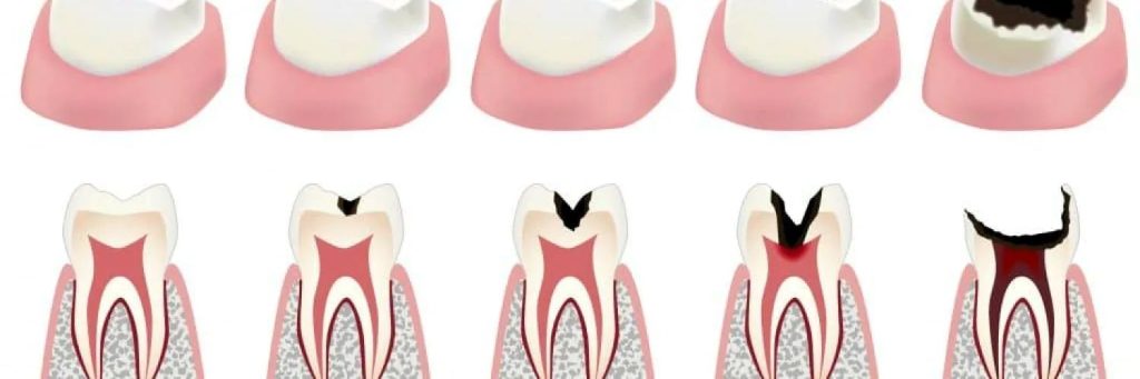 5 giai đoạn khiến sâu răng bị nặng