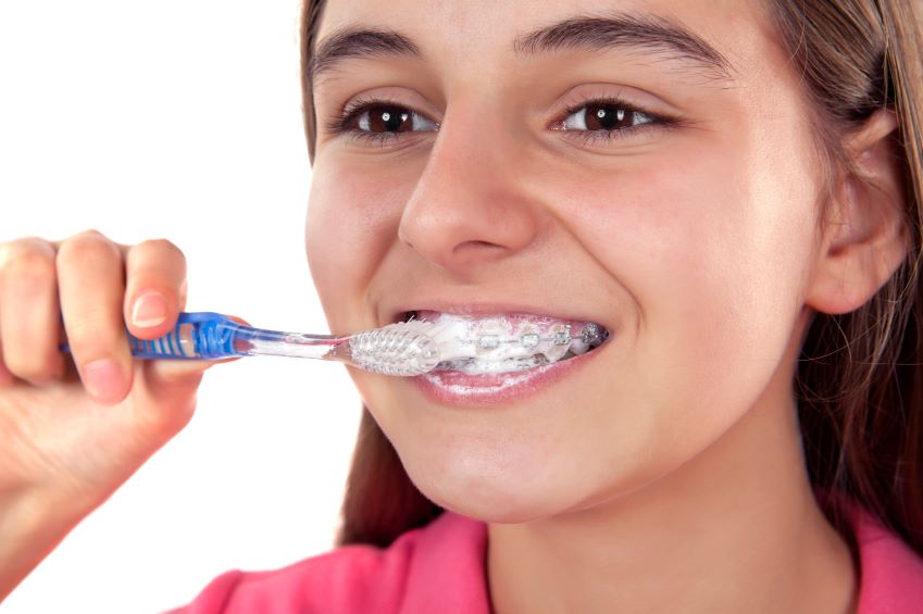 Trẻ niềng răng cần chải răng ít nhất 2 lần/ngày, mỗi lần 2 phút.