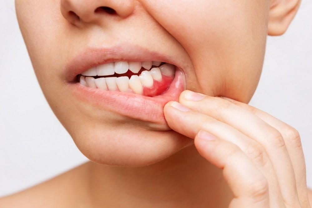 Viêm nướu cũng là 1 trong những nguyên nhân khiến răng bị ê buốt